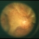 Fibrovascular Proliferation